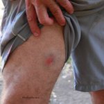 Paintball wounds