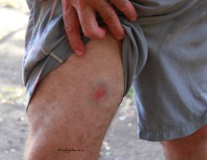 Paintball wounds